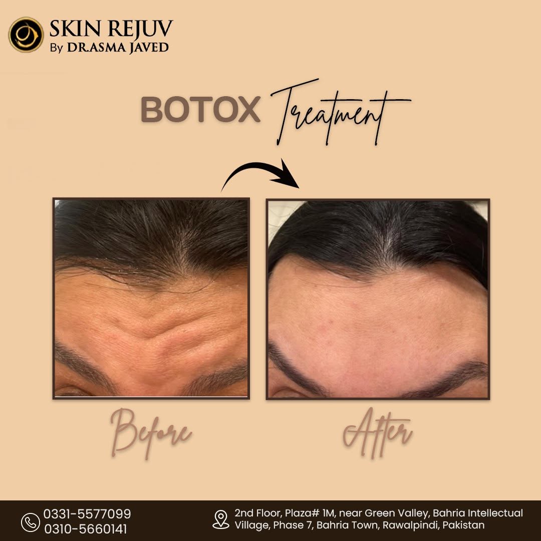 Before After Treatment 4